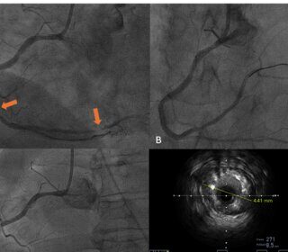 How Interventional Radiology Offers New Treatment Options for Heart Failure