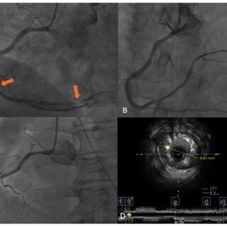 How Interventional Radiology Offers New Treatment Options for Heart Failure