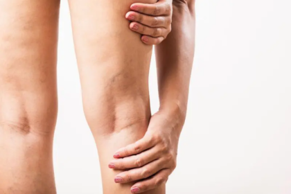 What to Expect During a Sclerotherapy Session