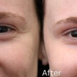 How Botox Works to Smooth Out Fine Lines and Wrinkles