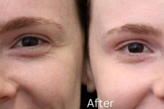 How Botox Works to Smooth Out Fine Lines and Wrinkles
