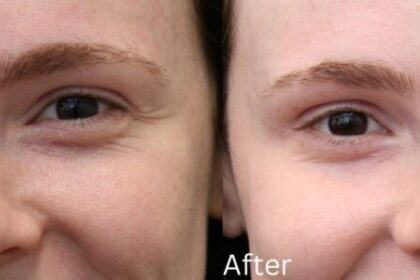 How Botox Works to Smooth Out Fine Lines and Wrinkles
