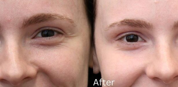 How Botox Works to Smooth Out Fine Lines and Wrinkles