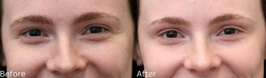 How Botox Works to Smooth Out Fine Lines and Wrinkles
