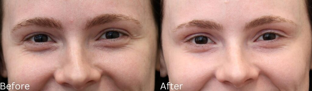 How Botox Works to Smooth Out Fine Lines and Wrinkles