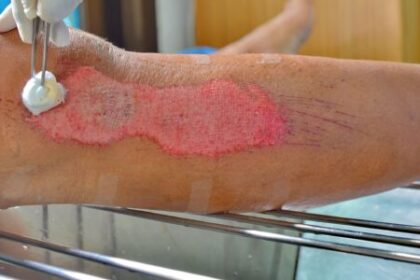 Understanding the Wound Healing Process